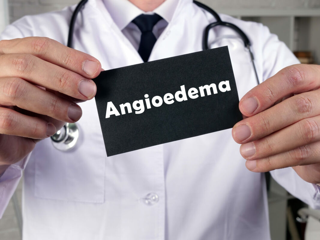 angioedema