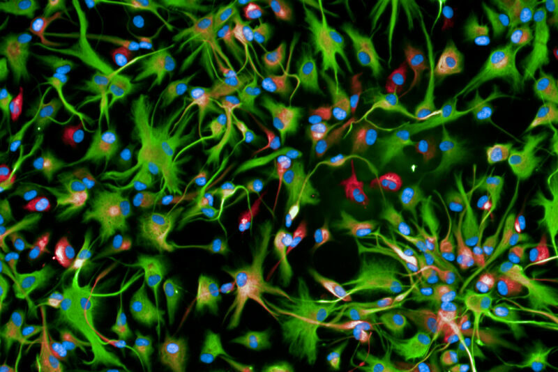 glioma