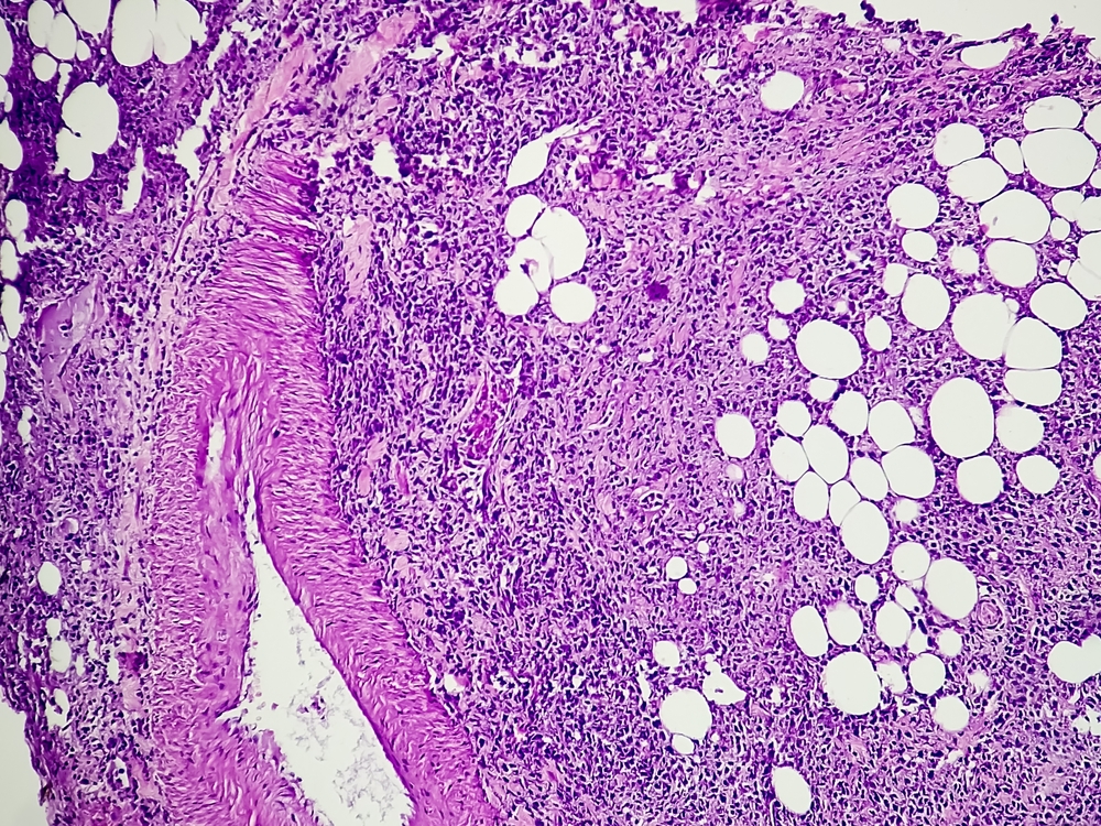 carcinoma vescica