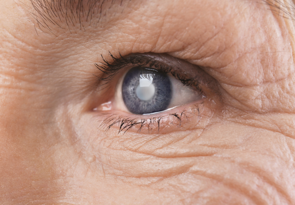 Cataract,Concept.,Senior,Woman's,Eye,,Closeup