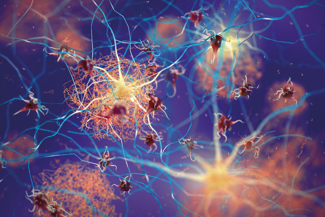 Amyloid plaques forming between neurons 3d ilustration. Beta-amyloid protein disrupting nerve cells function in a brain with Alzheimer's disease