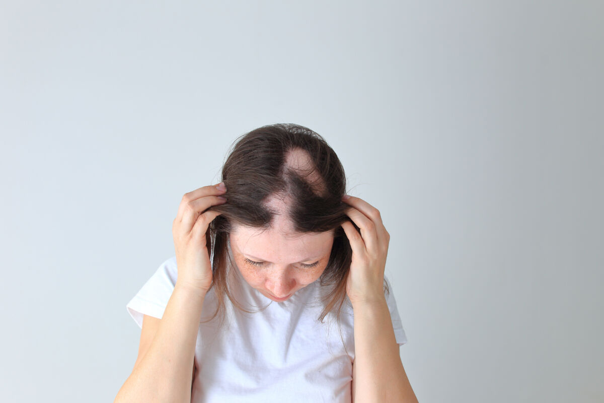 alopecia areata