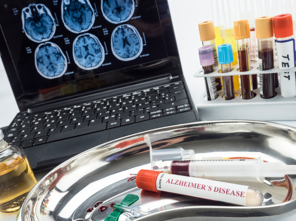 test Alzheimer