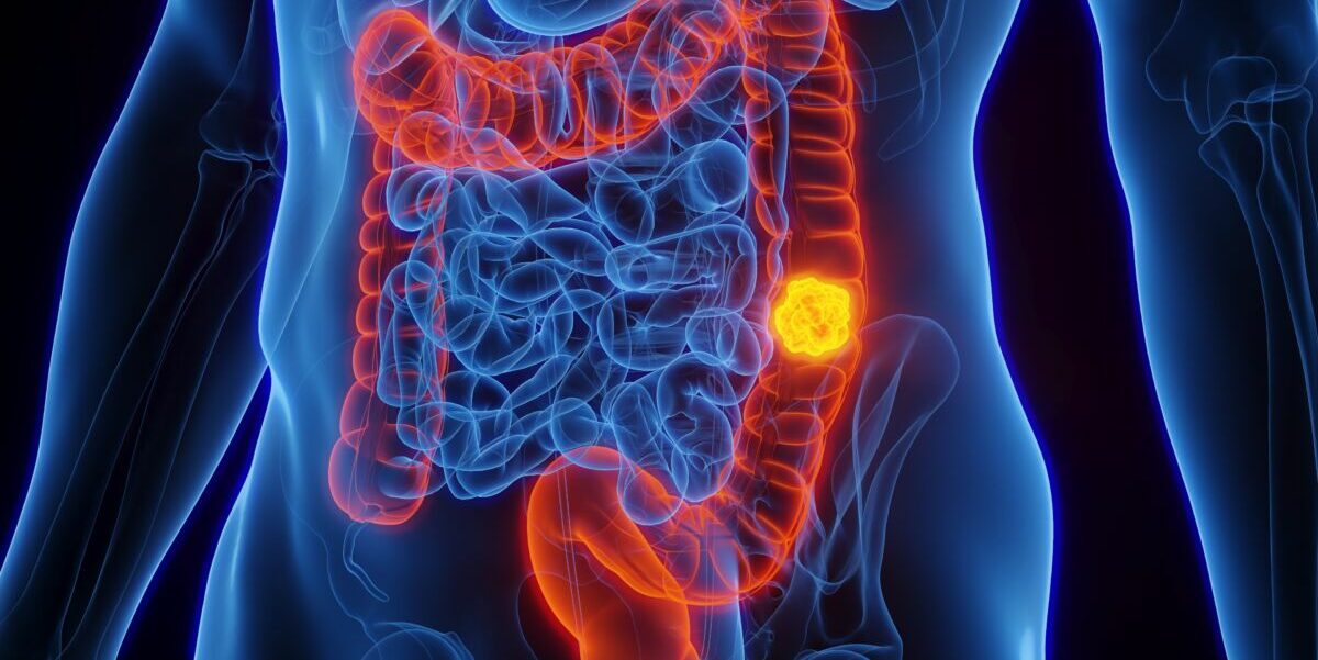 tumore al colon