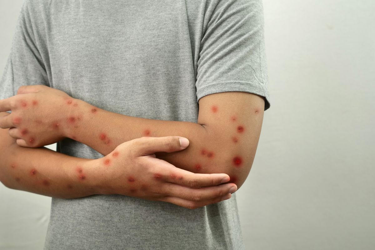 morbillo