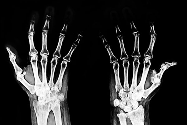 X-Ray of hand with rheumatoid arthritis. Medical themes