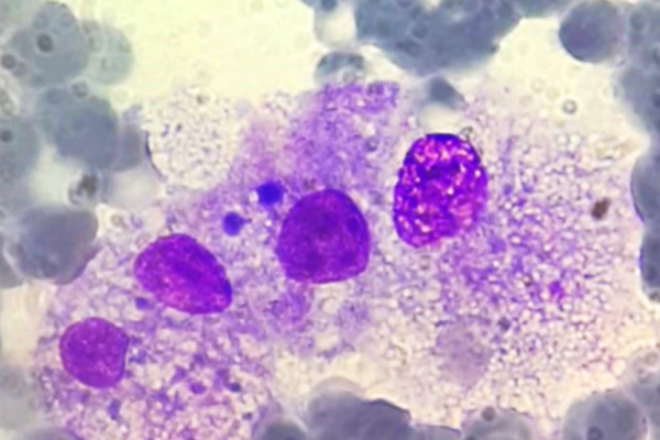 macrofagi aggrediscono le cellule sane