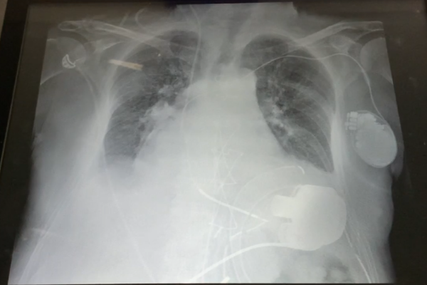 Radiografia impianto Lvad