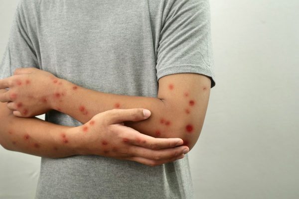 morbillo
