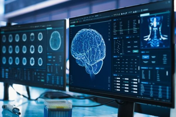 cervello ricerca Alzheimer Parkinson