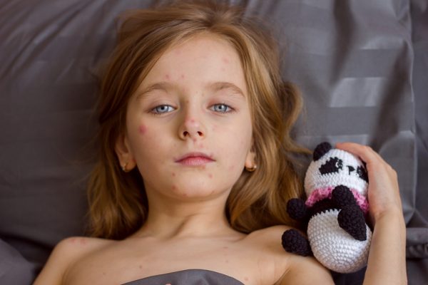 morbillo Italia